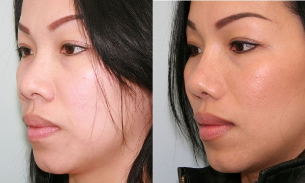 Enhancing Asian Beauty A Guide to Rhinoplasty Nose Reshaping
