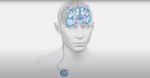 How Deep Brain Stimulation Surgery is Transforming Neuroscience
